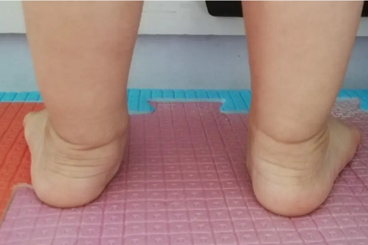 小孩马蹄外翻足图