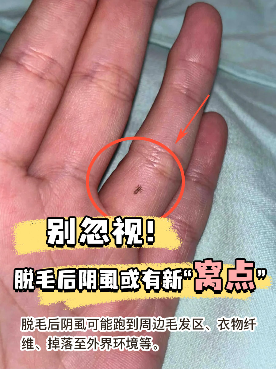 别忽视！脱毛后阴虱或有新“窝点”