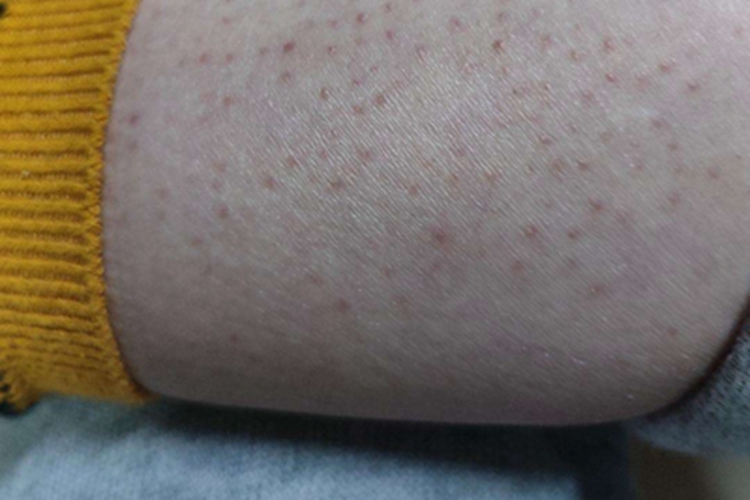 毛囊角化病小腿症状图