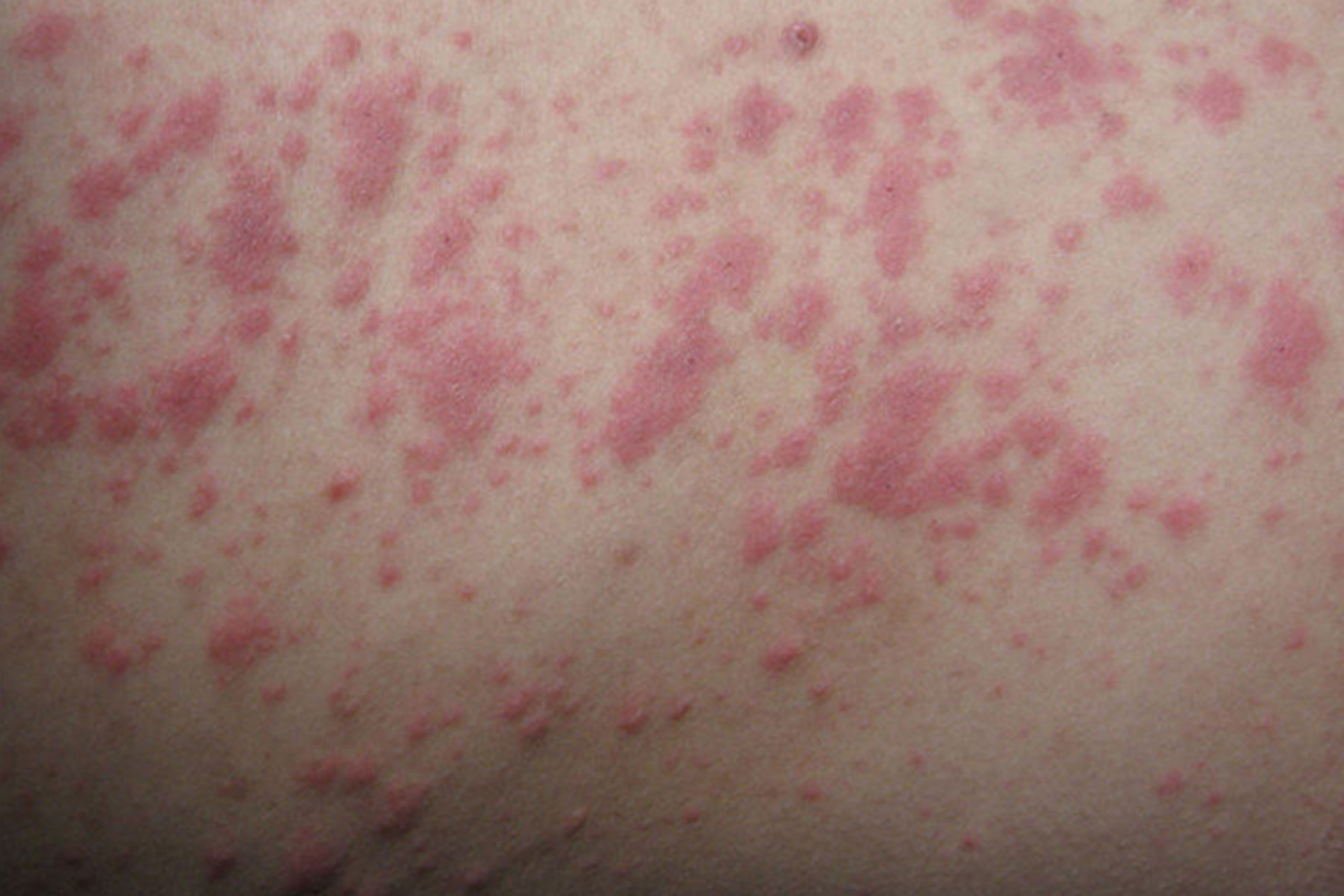 螨虫皮炎丘疹图