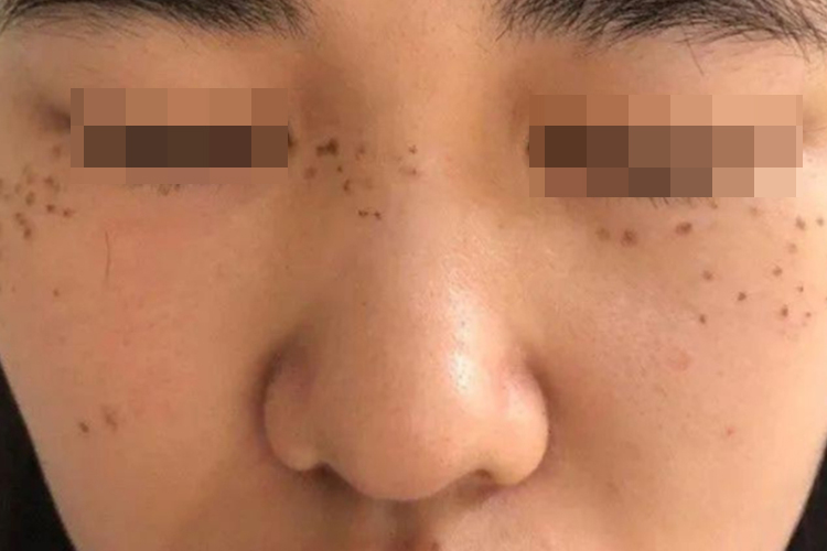 皮秒祛斑后10天图