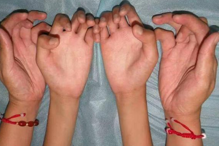 先天性尺偏手畸形图