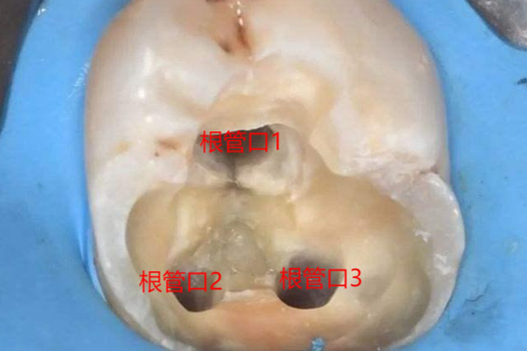 下颌第一磨牙根管口分布图 下颌第一磨牙根管口分布图