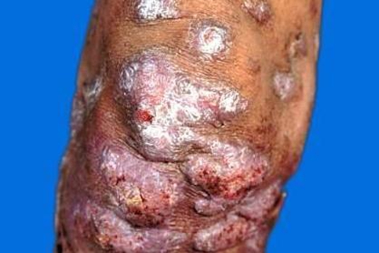 着色真菌病胳膊症状图