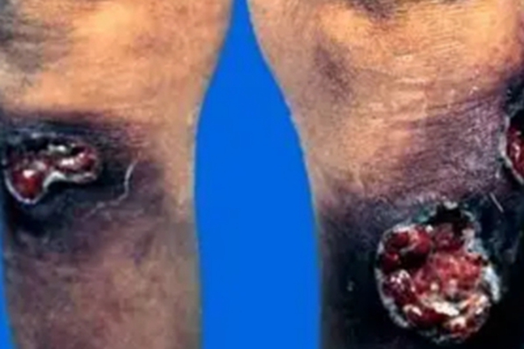 三期梅毒小腿症状图