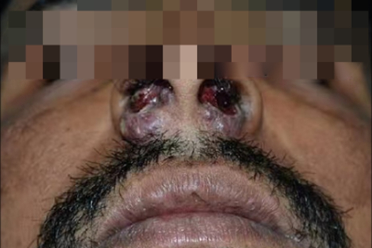 硬结期鼻硬结病症状图