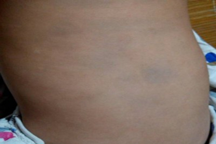 伊藤痣背部被淡青色斑覆盖图