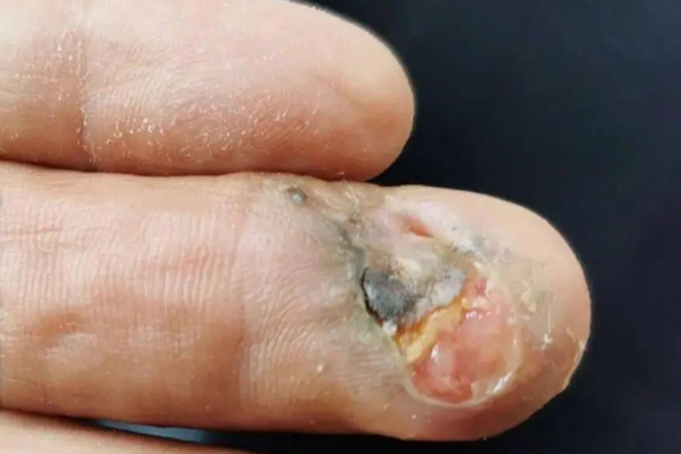 坏疽糖尿病患者易发生皮肤各种病原菌感染,手部溃烂轻微多为坏疽,手癣