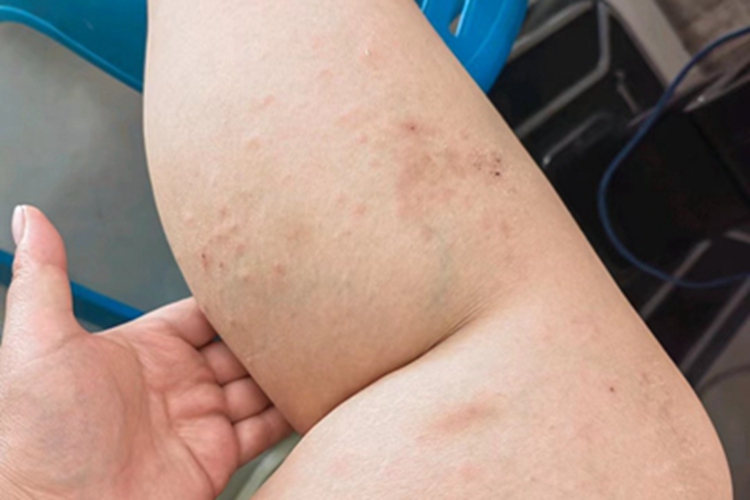 亚急性湿疹小腿小疙瘩图