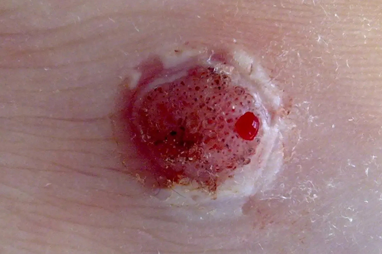 疣冷冻脱落后有红色肉芽图片