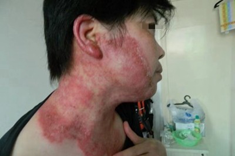 体癣侧颈症状图