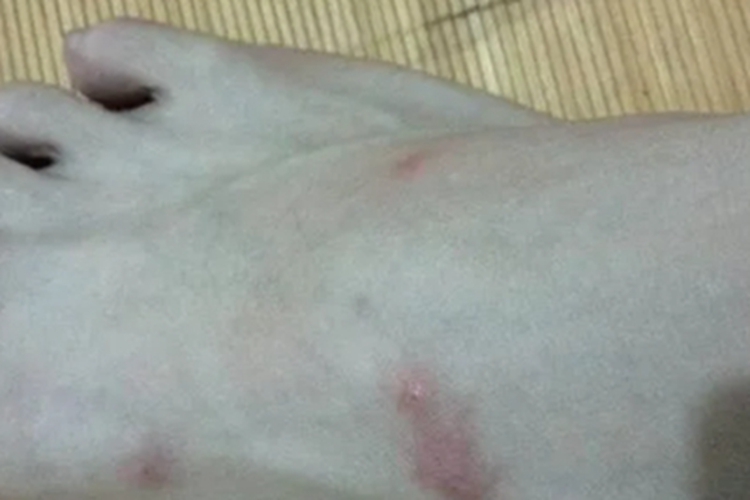 蠓虫叮咬脚上有红斑图
