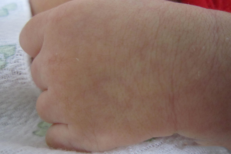 新生儿毛细血管明显图 新生儿毛细血管明显图