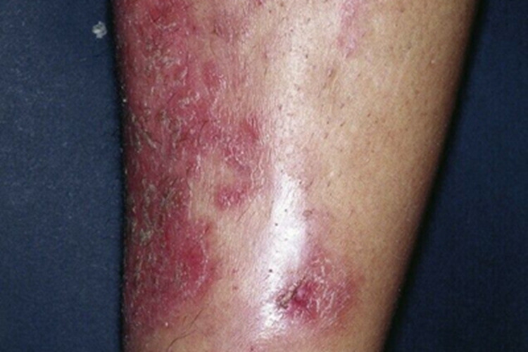 硬结性红斑小腿结痂图 硬结性红斑小腿结痂图