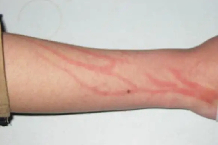 浅表性静脉炎早期图