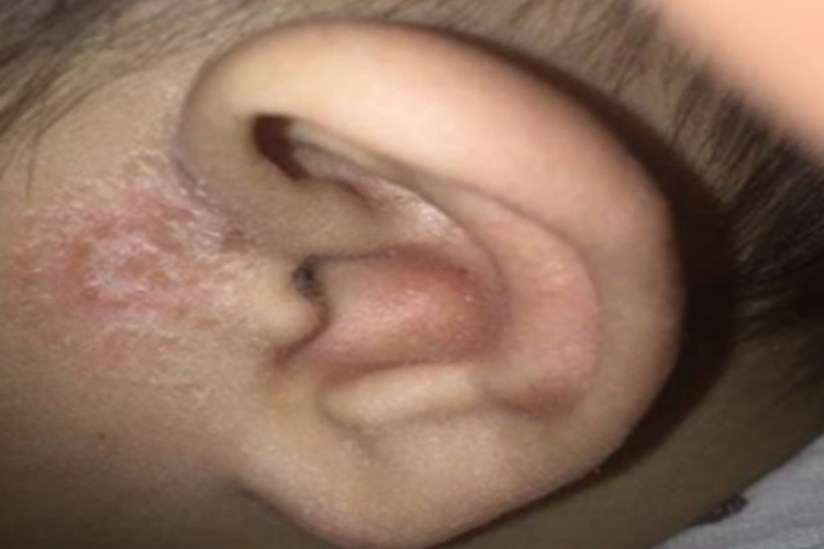 面癣耳周脱屑图 面癣耳周脱屑图