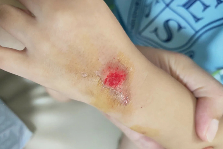 小孩手背擦伤表皮破损图 小孩手背擦伤表皮破损图