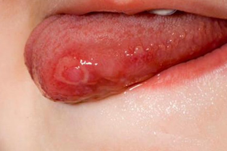 两岁宝宝轻型阿弗他溃疡图