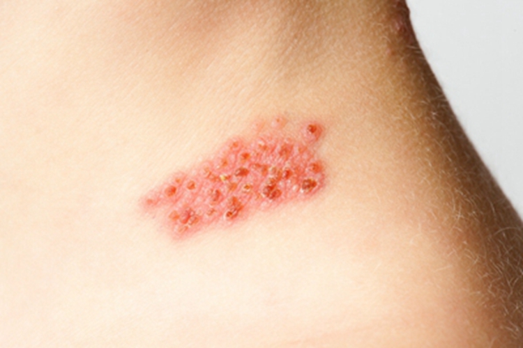 带状疱疹颈部结痂图