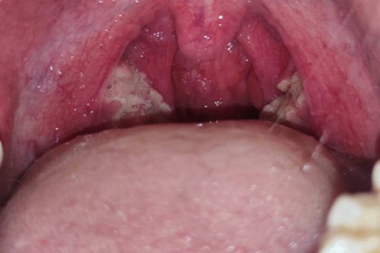 慢性扁桃体炎图