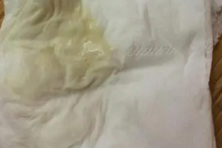 萎缩性阴道炎排出黄色液体图