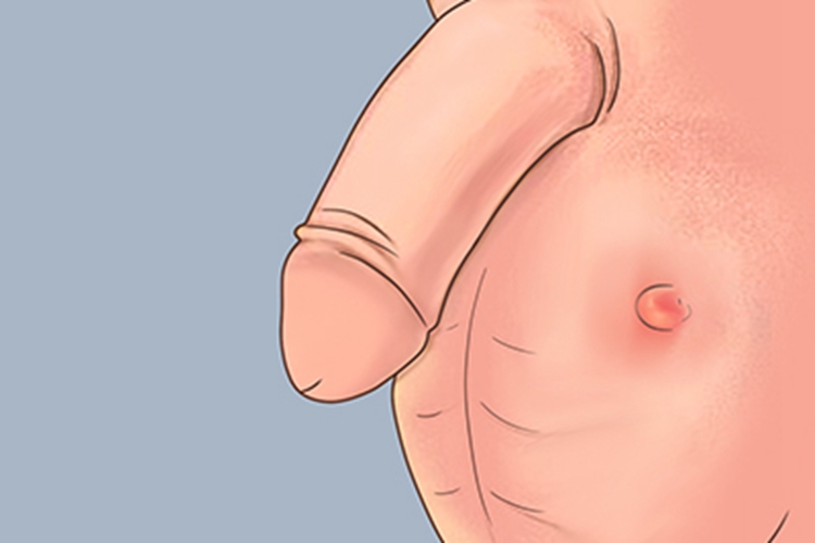 阴囊皮脂腺囊肿图