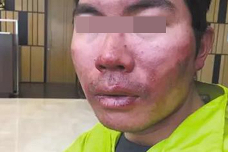 Ⅲ度冻伤症状图