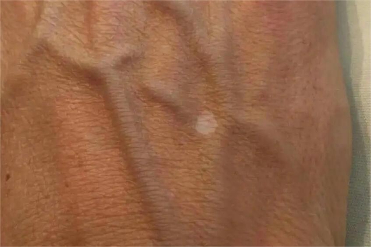 未定类型白癜风手背症状图 未定类型白癜风手背症状图