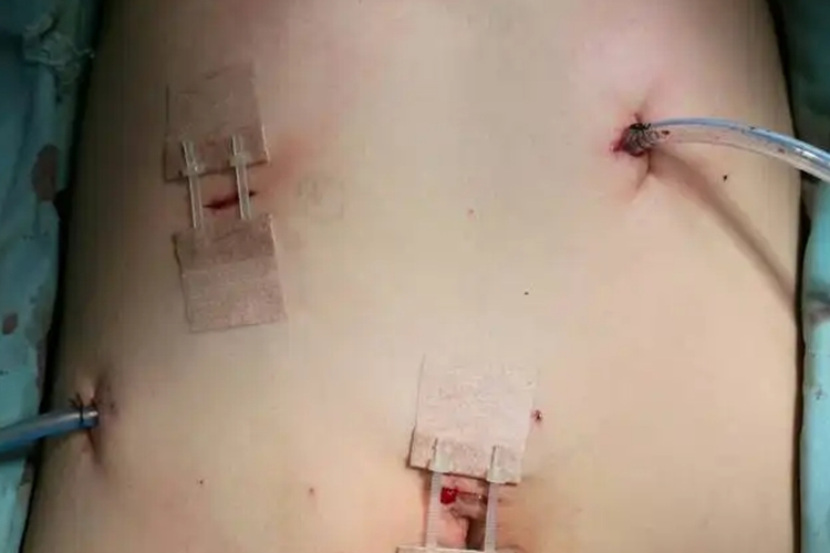 放置引流及缝合图