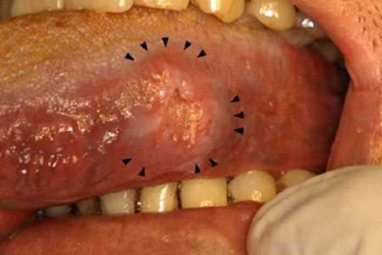 舌癌舌头糜烂图 舌癌舌头糜烂图