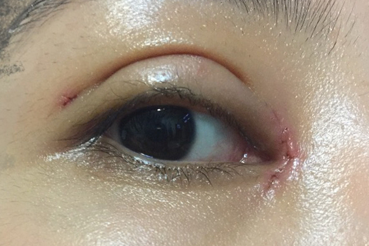 内眼角瘢痕增生图