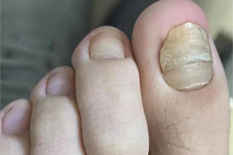 脱甲病条纹图 脱甲病条纹图