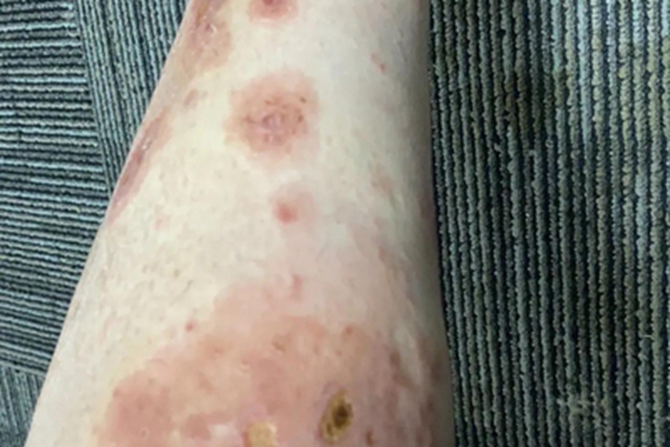 皮肤小血管炎小腿黄痂图 皮肤小血管炎小腿黄痂图