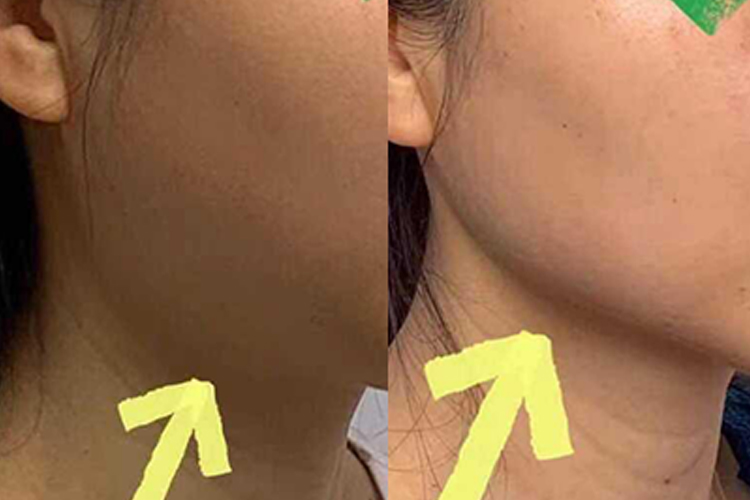 热玛吉对比效果图 热玛吉对比效果图