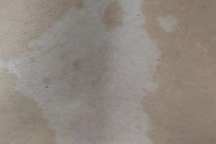 泛发型白癜风背部白斑图