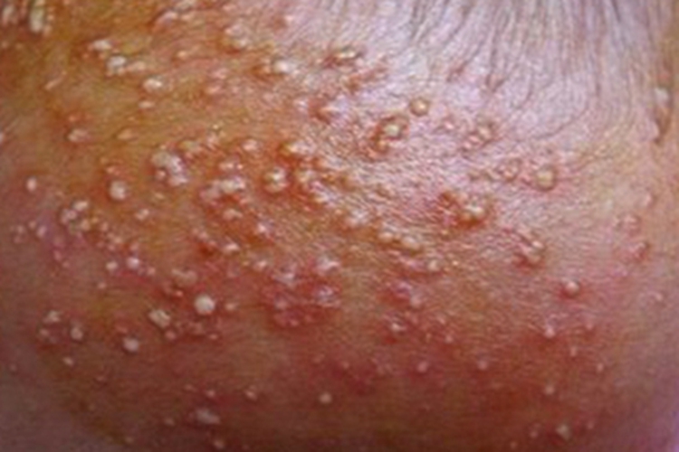 脓痱症状图 脓痱症状图