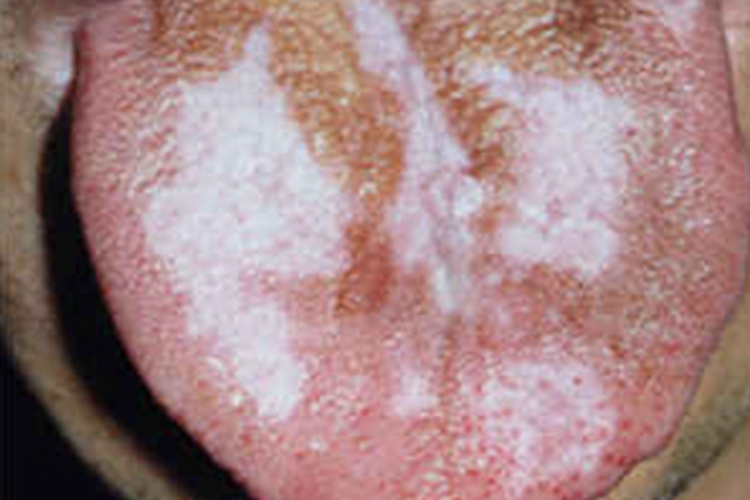 萎缩型口腔扁平苔藓舌头白斑图 萎缩型口腔扁平苔藓舌头白斑图