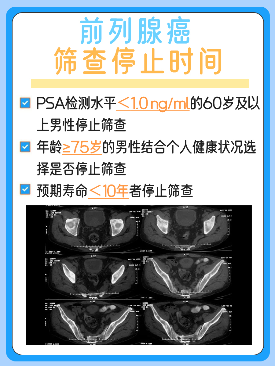 前列腺癌叫假癌?揭秘其特殊性质