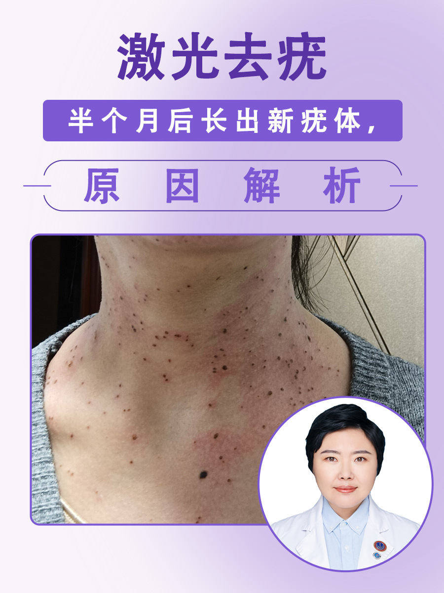 激光去疣半个月后长出新疣体，原因解析