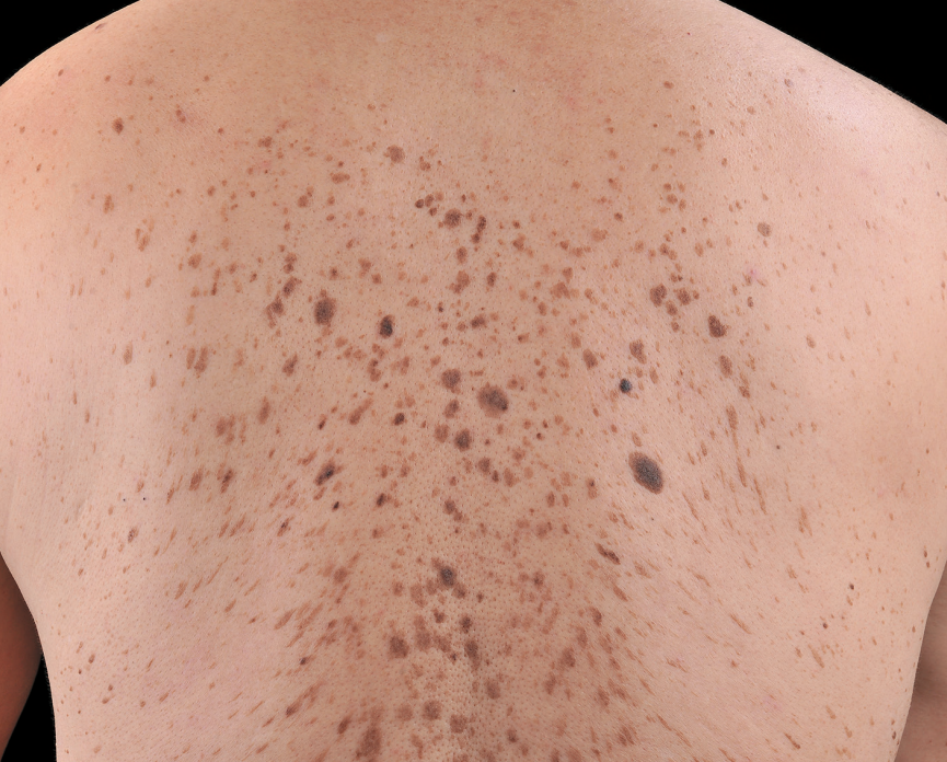 脂溢性角化病图