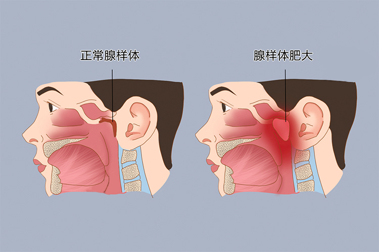 腺样体肥大图