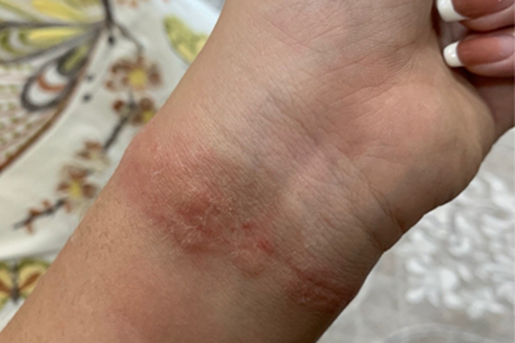 慢性接触性皮炎手腕症状图