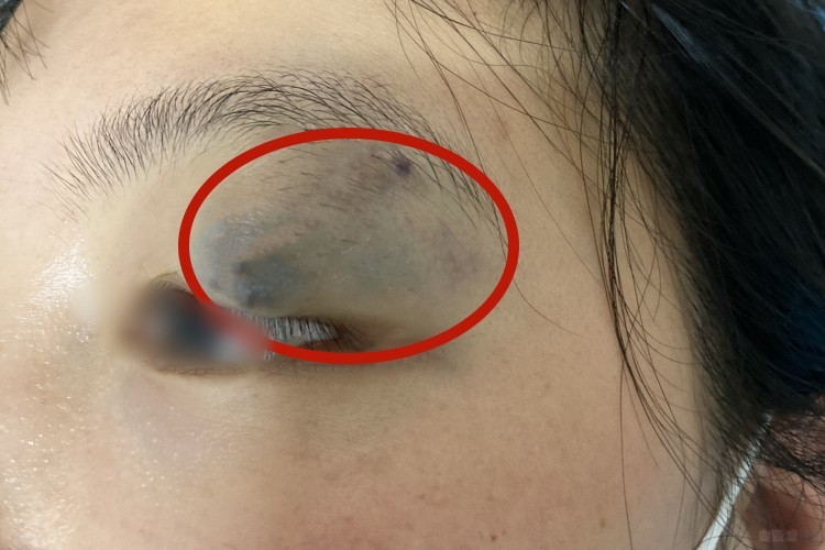 静脉畸形眼周皮肤发紫图