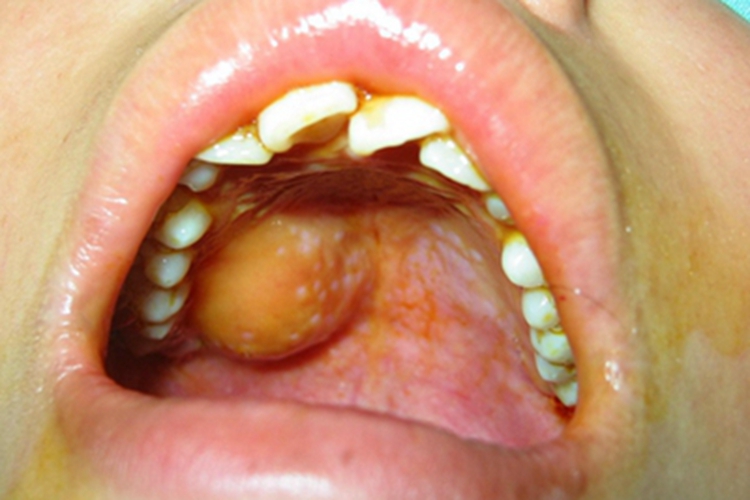 成人型纤维肉瘤口腔症状图