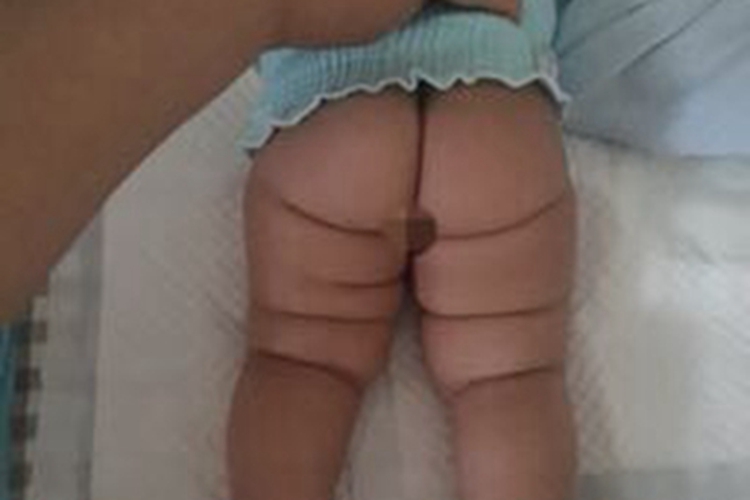 先天性髋关节脱位腿上多条横纹图