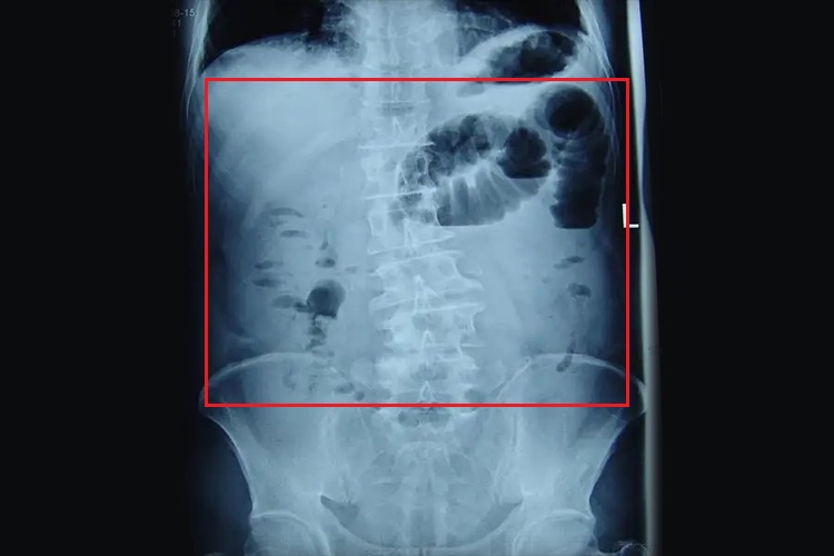 麻痹性肠梗阻DR影像图