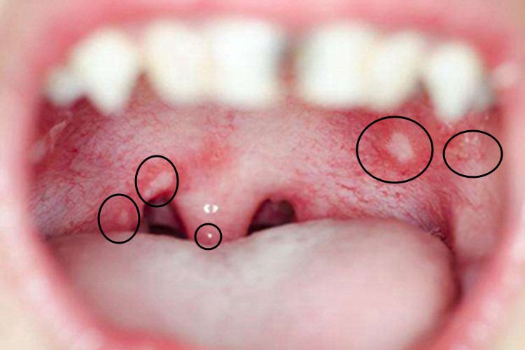 疱疹性口炎溃疡图