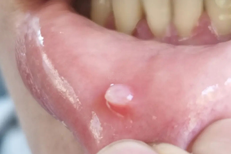 下嘴唇黏液腺囊肿图