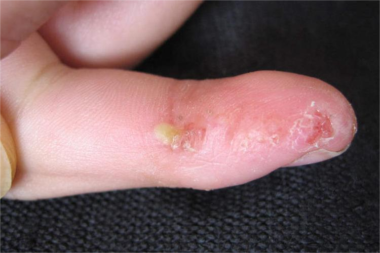 连续性肢端皮炎化脓图 连续性肢端皮炎化脓图