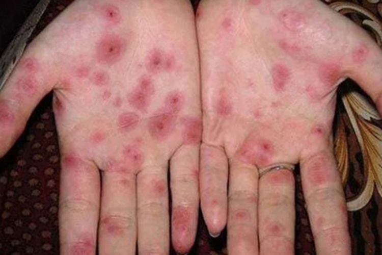 艾滋病手掌圆疙瘩图
